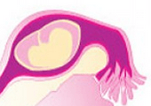 grossesse extra uterine en chiffres