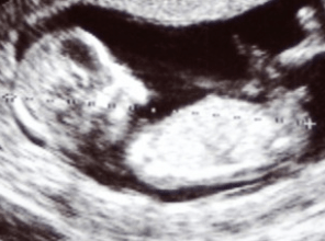 3ème échographie à 8 mois de grossesse